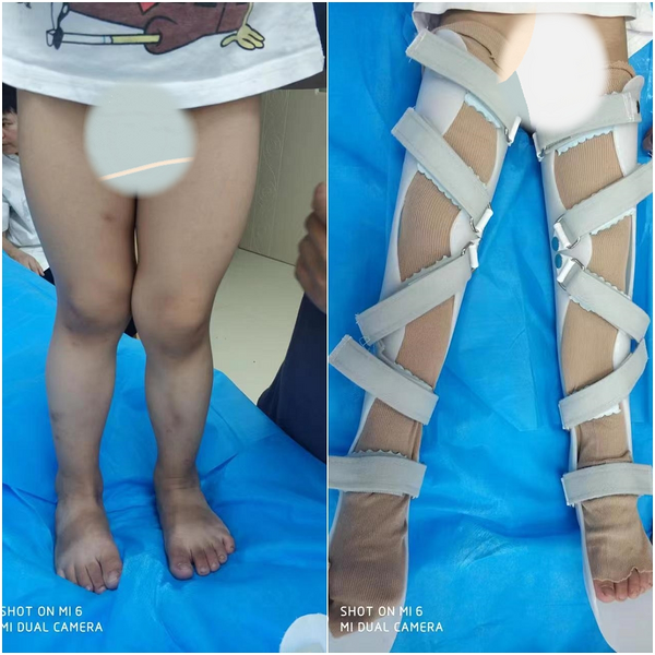 喜莱健&nbsp;aaa膝踝足矫形器一只 X型腿 膝关节外翻（定制成人或儿童）&nbsp;定制型